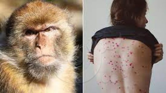 منظمة الصحة العالمية تحذر من عودة خطر جدري القرود