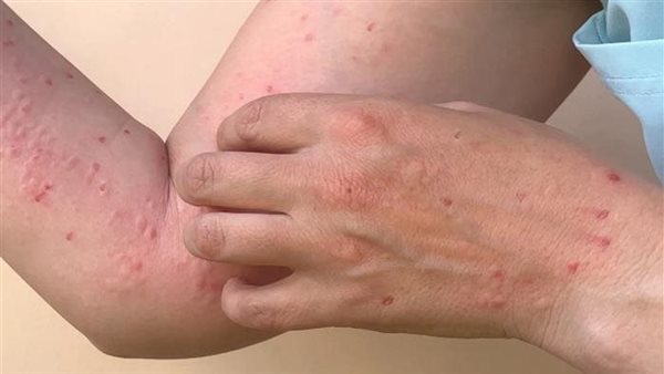 المستشفيات الجامعية بالقليوبية تنفى تسجيل أول حالة لجدري القرود - 3 - سيناء الإخبارية