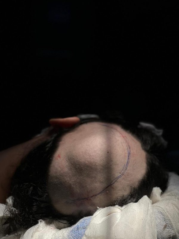 الصحة: جراحة متطورة تعيد الشكل الطبيعي لجمجمة فتاة باستخدام تقنية الطباعة ثلاثية الأبعاد - 1 - سيناء الإخبارية