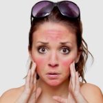 طريقة علاج حرقان البشرة بعد التعرض للشمس بمكونات طبيعية - 1 - سيناء الإخبارية