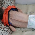 تقرير أممي يحذر من تفاقم أزمة سوء التغذية بين أطفال غزة - 18 - سيناء الإخبارية