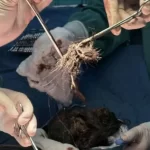 استخراج كرة شعر تزن 2 كجم من معدة مراهقة بعد 6 سنوات من المعاناة - 1 - سيناء الإخبارية