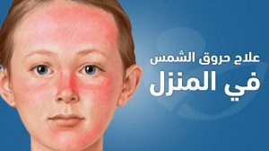 احذر موجة الحر: الحروق الشمسية ليست مجرد احمرار بل خطر يصيب جلدك ومناعتك - 1 - سيناء الإخبارية